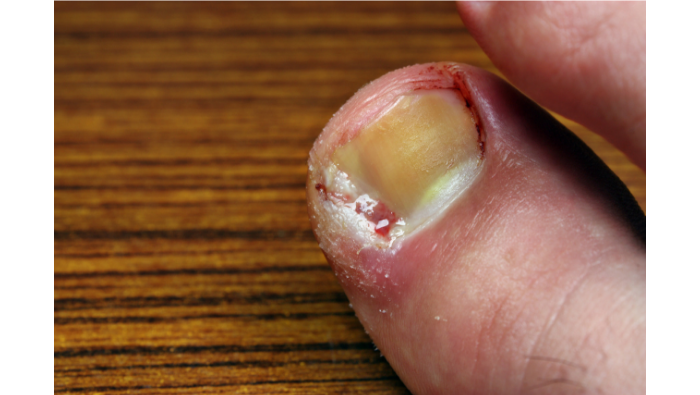 5 Tips On Preventing An Ingrowing Toenail West Berkshire Foot Clinic