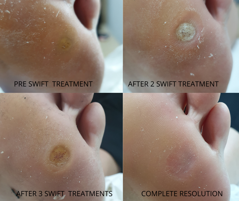 Verruca before and after Swift treatment