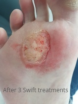 Foot after 3 Swift treatments