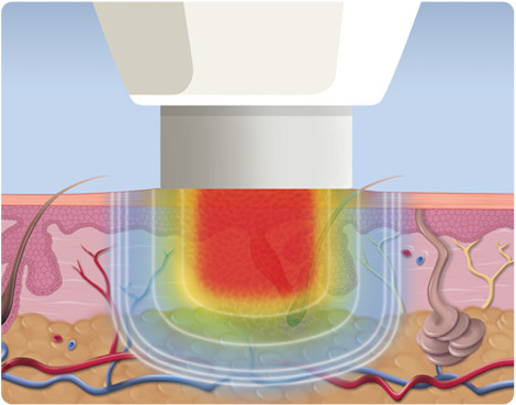 Swift® uses microwave energy to treat the verruca