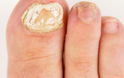 Why do I need to test my fungal nail?