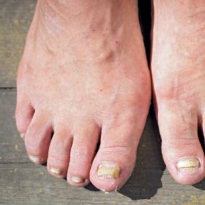 Conditions and Treatments - West Berkshire Foot Clinic