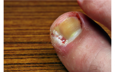 5 tips on preventing an ingrowing toenail