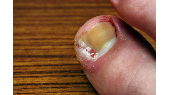 5 tips on preventing an ingrowing toenail