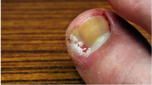 mild ingrown toenail