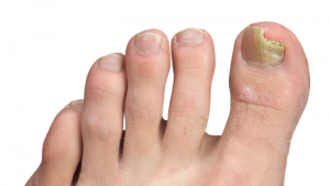 fungal nail