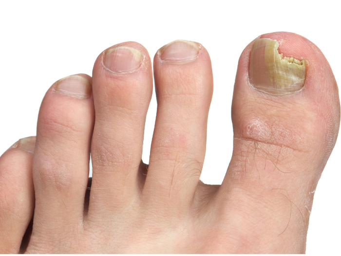 Toe Nail Fungus - Natural Remedies that WORK