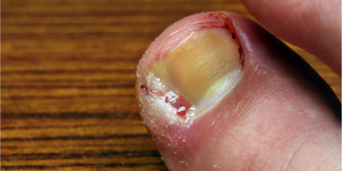 Broken toenail hi-res stock photography and images - Alamy
