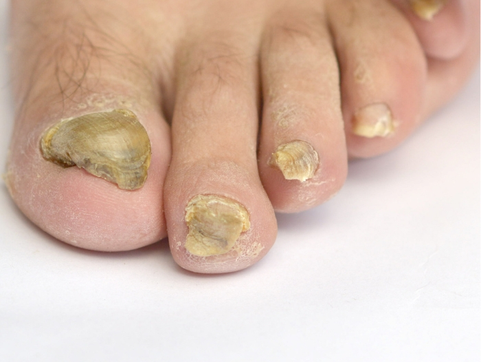 thickened toenails