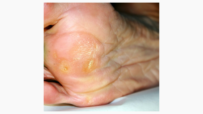 Can A Podiatrist Remove Dead Skin on the Feet