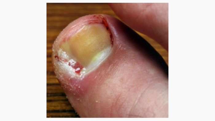 Ingrowing-toenails