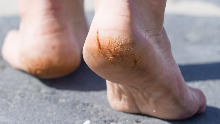 Dry Cracked Heels Treatment New York City | Gotham Footcare