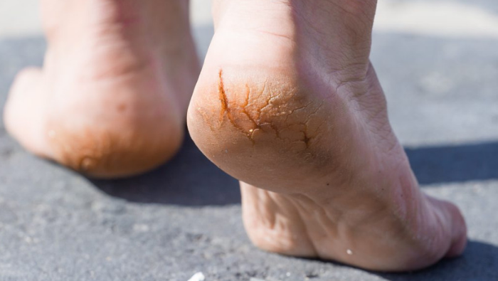 Macro-photo-pair-of-cracked-heels.-Male-back-view