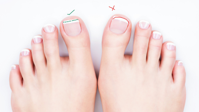 Should I be cutting toenails with a 'v' shape? - West Berkshire Foot Clinic