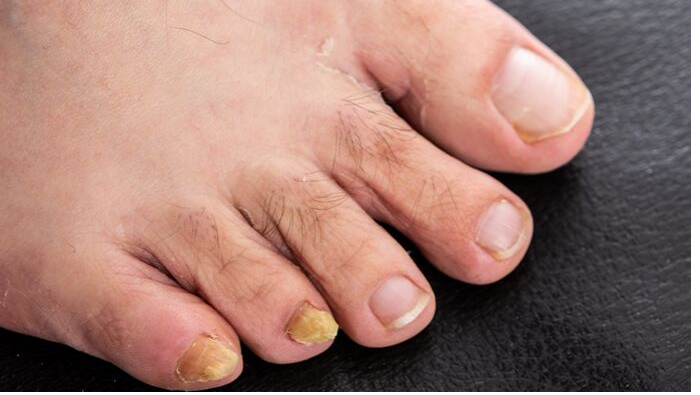 Does Tea Tree oil treat fungal nails? - West Berkshire Foot Clinic
