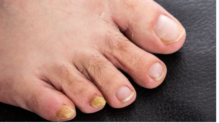 How to Stamp Out Toenail and Foot Fungus