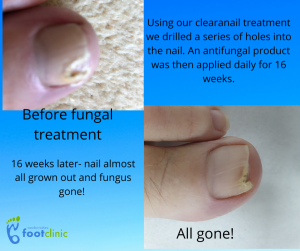 fungal nail treatment