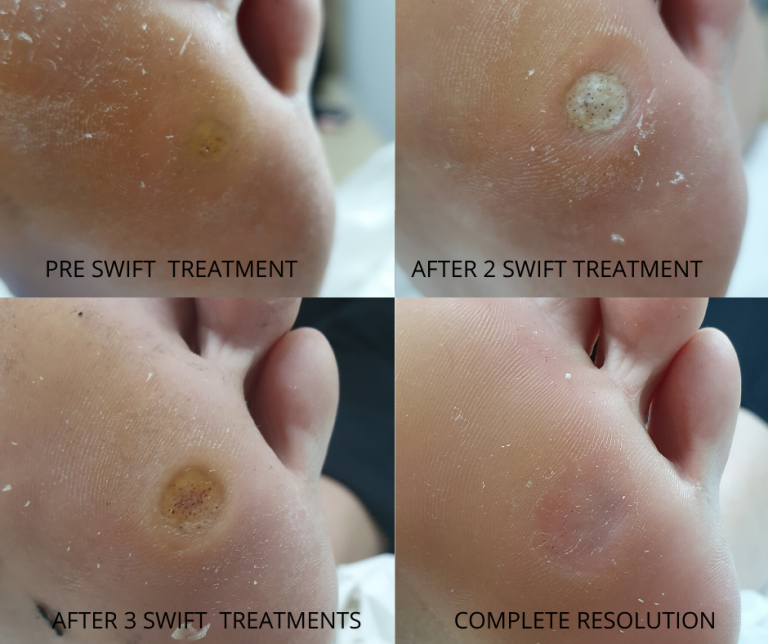 Swift® Verruca Treatment - West Berkshire Foot Clinic