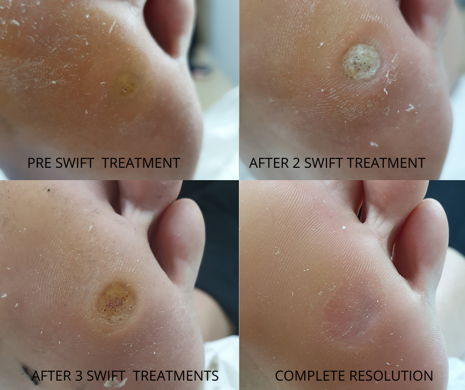 Why Should I Use Swift To Treat My Verruca West Berkshire Foot Clinic