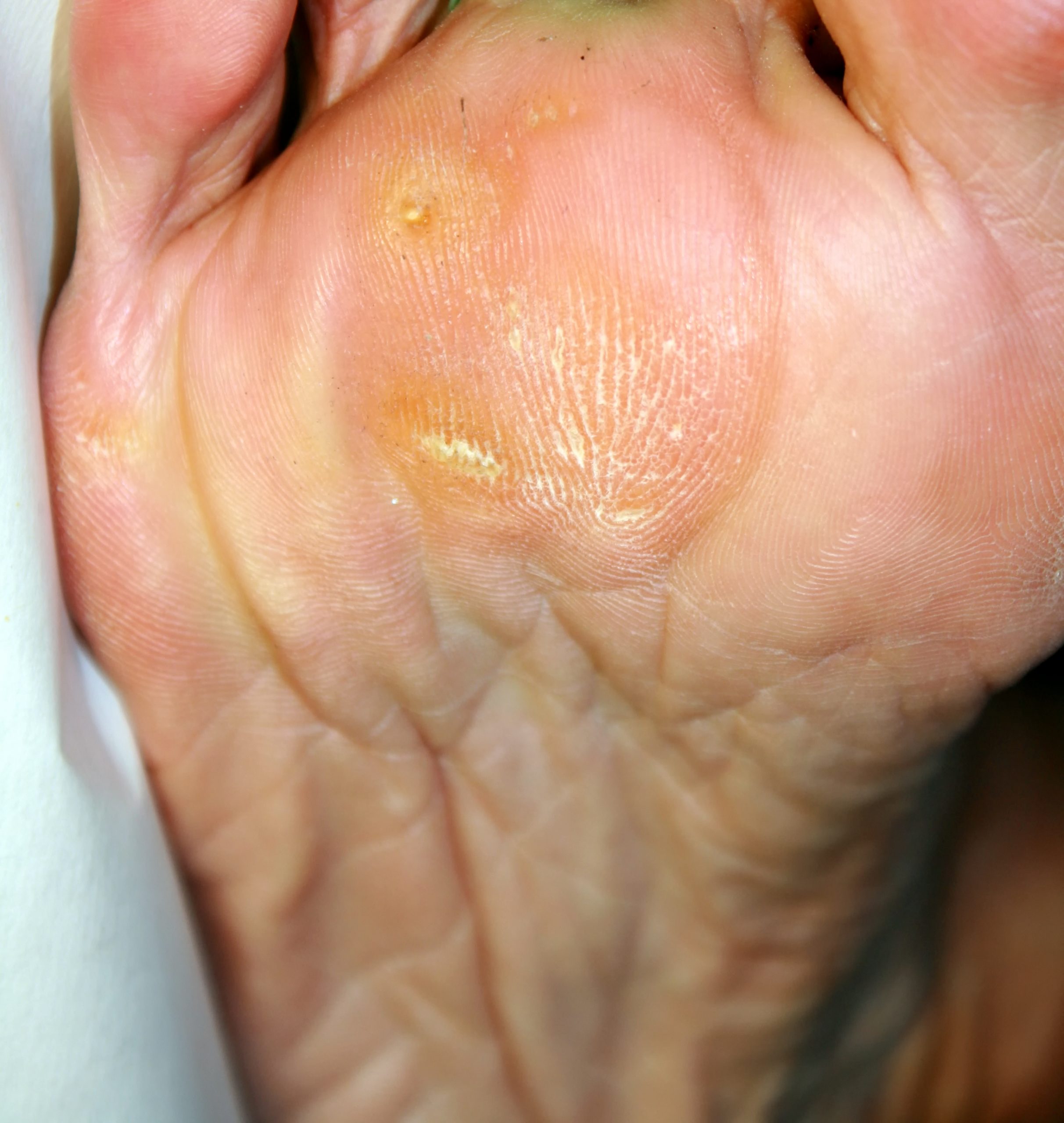 Callus vs Wart (and Corns) - Pinch Callus Removal