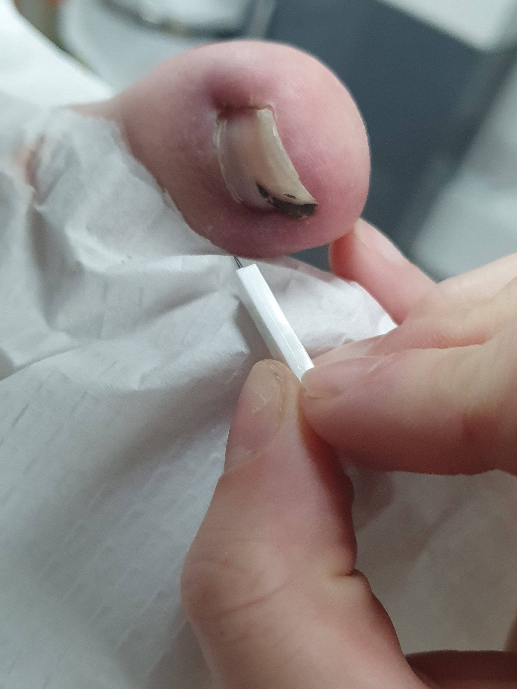 Toenail during nail surgery